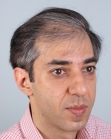 Before Hair Transplant&nbsp;2 Sessions (Areas)